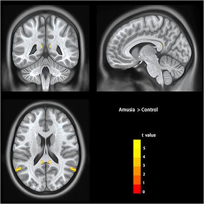 Increased Resting-State Interhemispheric Functional Connectivity of Posterior Superior Temporal Gyrus and Posterior Cingulate Cortex in Congenital Amusia